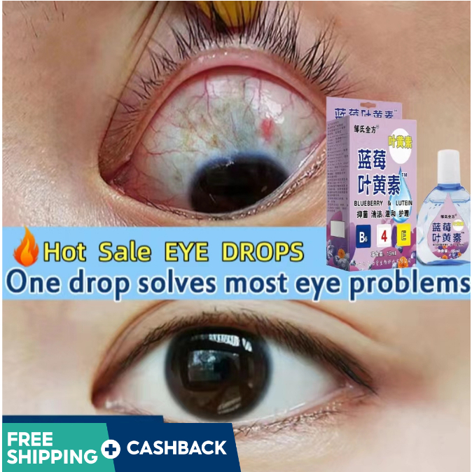 Blueberry Eye Drops Itchy Eyes Eye Drops Dry Eyes Eye Drops