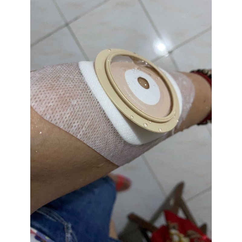 OxMed colostomy baseplate 60mm (bag not included) | Shopee Philippines