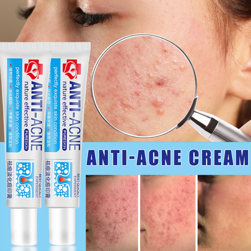 Antiacne Cream Acne Remover Treatment Brightening Moisturizing Skin
