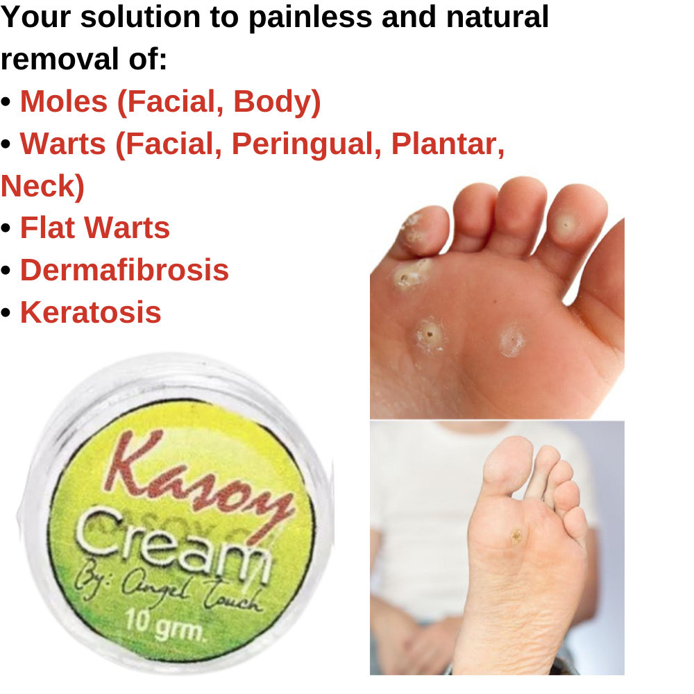 Combo Pack Kasoy Oil and Kasoy Cream Warts Kulugo Remover | Shopee ...