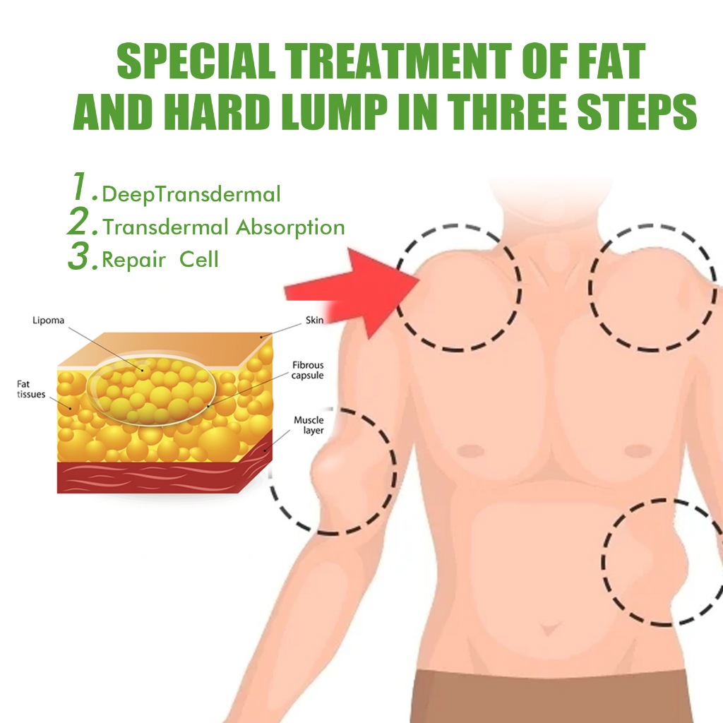 OUHOE Lipoma Removal Cream 20g Treatment Skin Swelling Lump Cellulite ...