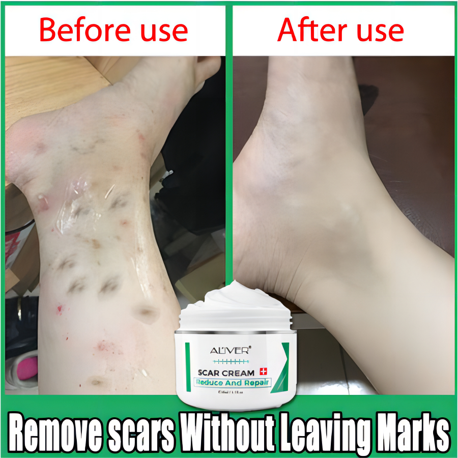 Treatment for Pimples on Your Legs - Healthline