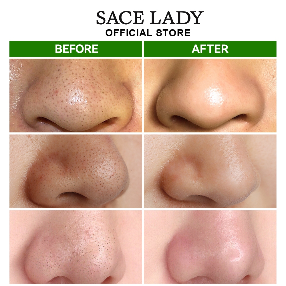 SACE LADY Blackhead Removal Nursing Serum Deep Clean Purify Gentle ...