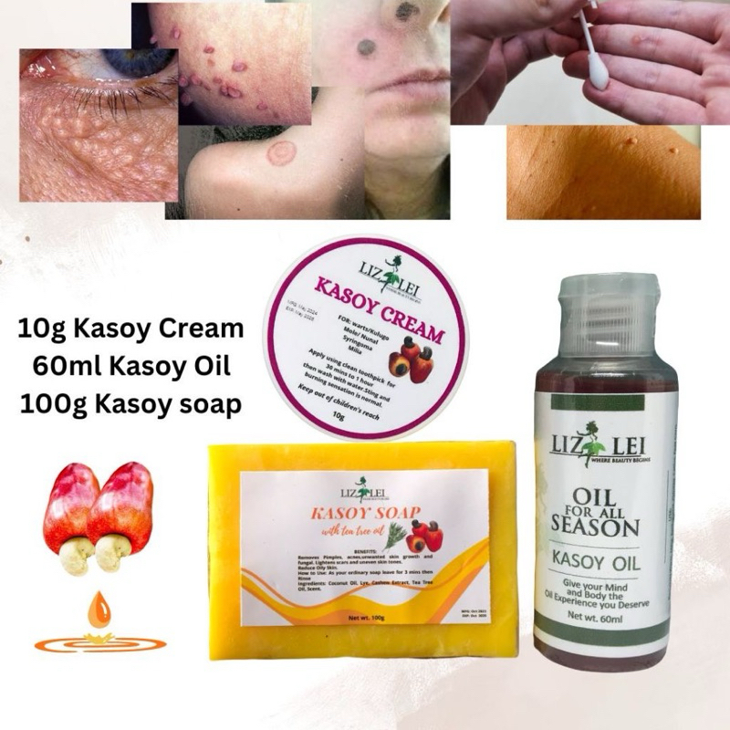 Kasoy Oil, Kasoy cream, Kasoy soap for warts skin tags moles ringworm ...