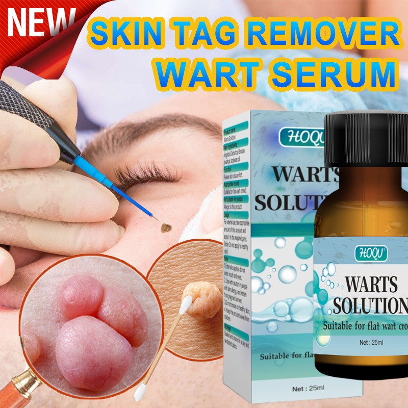 25ml Warts Remover Skin Tags & Mole Remover Kasoy Oil Kulugo Remover ...