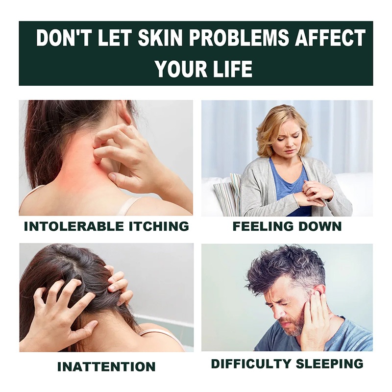 20G Antibacterial Anti-itching Eczema Cream Herbal Anti Fungal ...