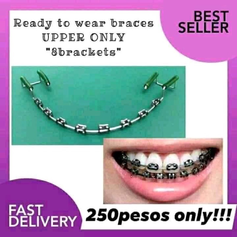 Ready to Wear Retainer Like (Braces BLACK UPPER ONLY) Shopee Philippines