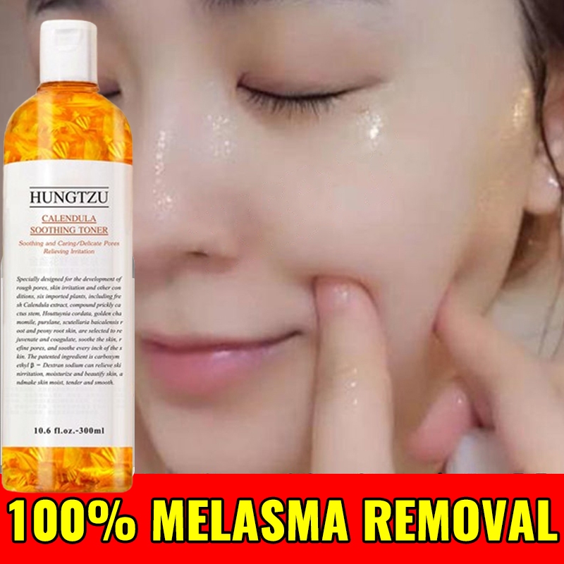 Calendula Toner For Acne And Pimple Marks Facial Toner Whitening Oil