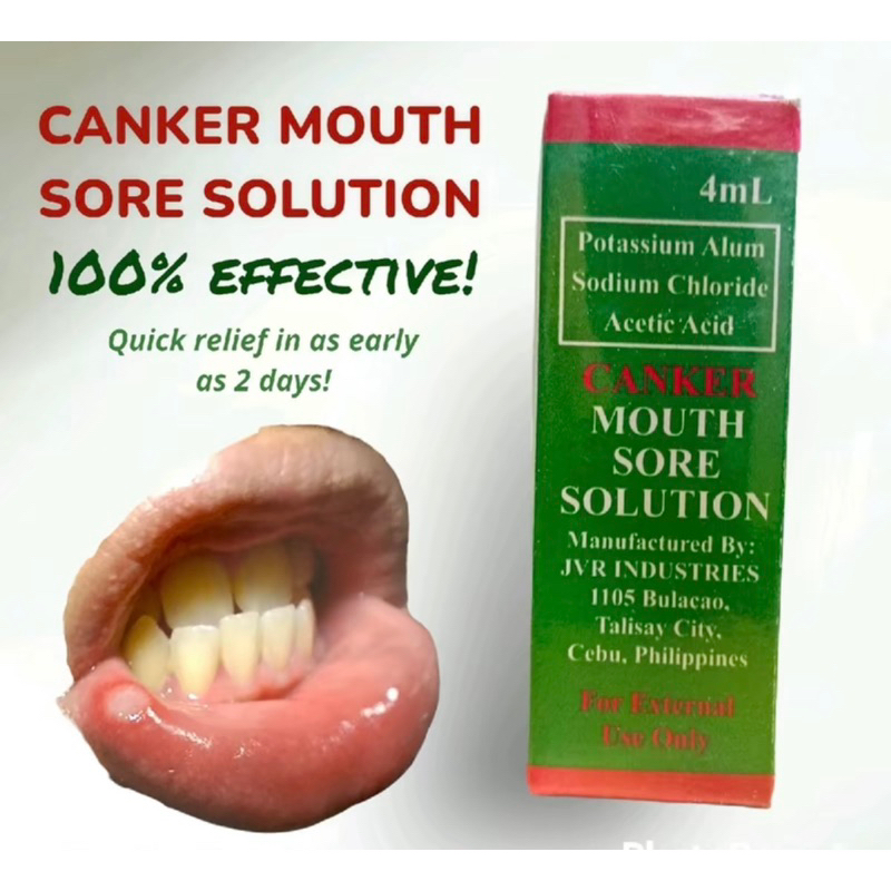 CANKER MOUTH SORE SOLUTION GAMUT SA SINGAW | Shopee Philippines