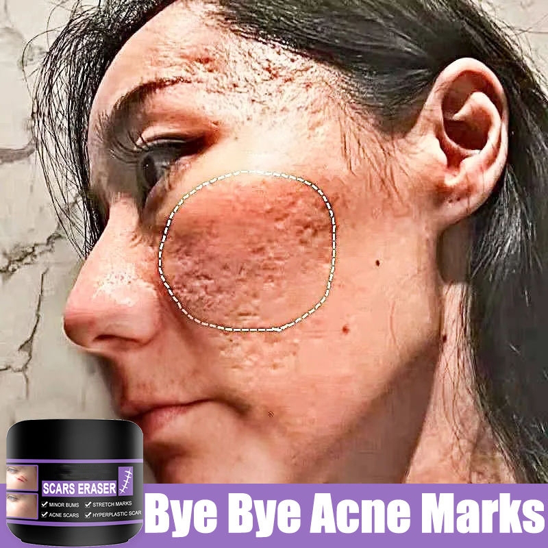 Scar Removal Serum for New and Old Scars Stretch Mark Removal