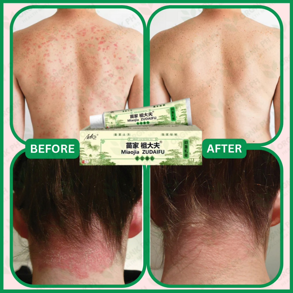 Buy 1 Take 1 Zudaifu Cream Original Ointment Pantanggal Kati Kati for ...