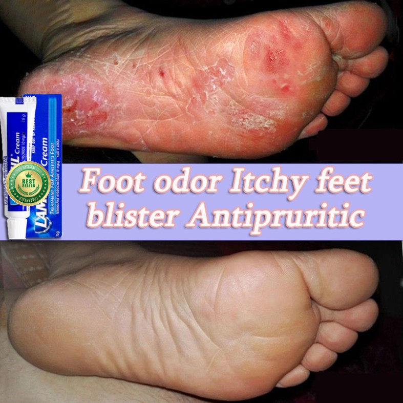 Antifungal Cream Athlete's Foot Cream for Beriberi ltching Tinea
