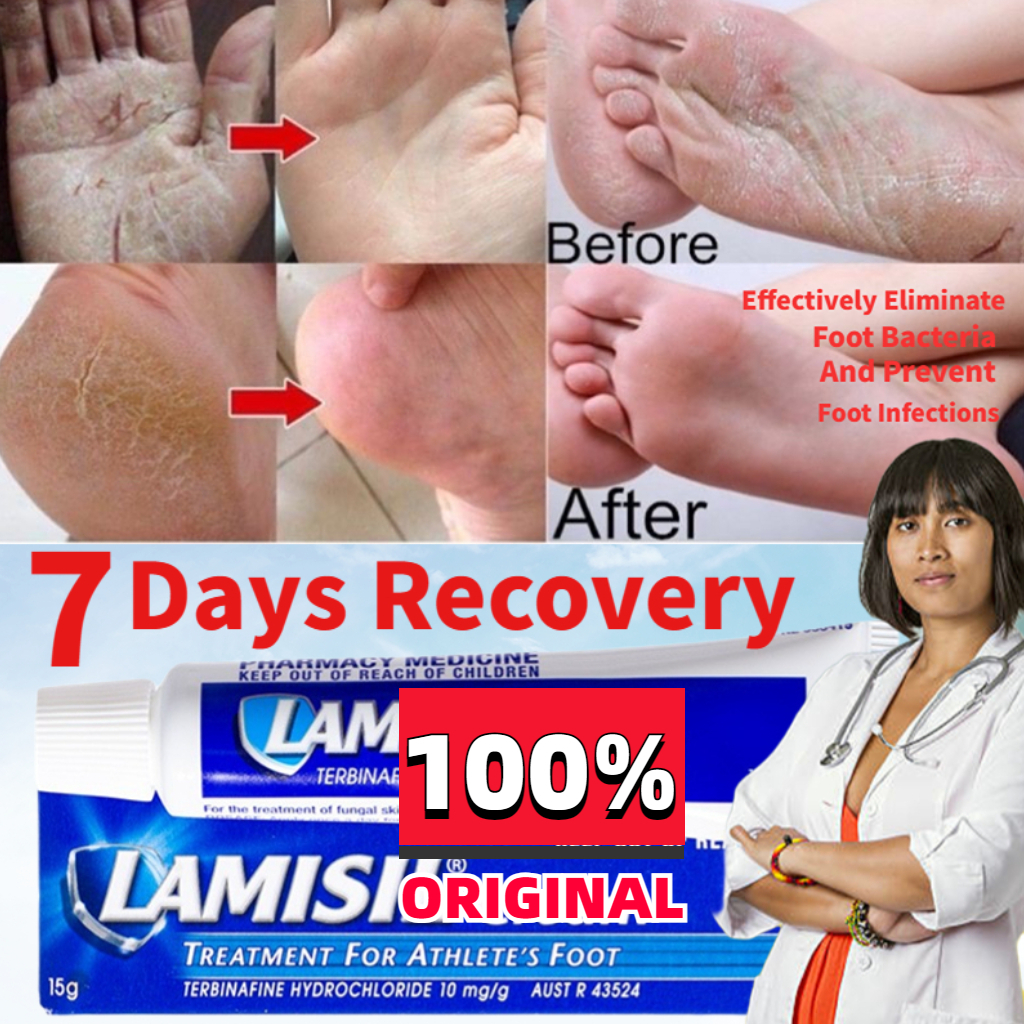 Antifungal Cream Athlete's Foot Cream for Beriberi Itching Tinea