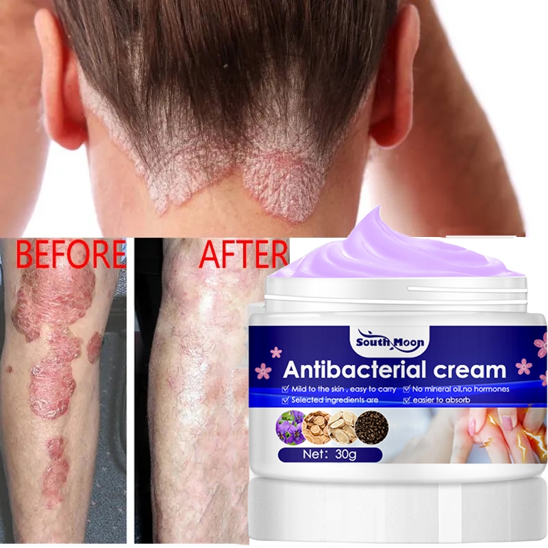 Eczema Treatment Cream Skin Itching Allergic Antifungal Cream Psoriasis