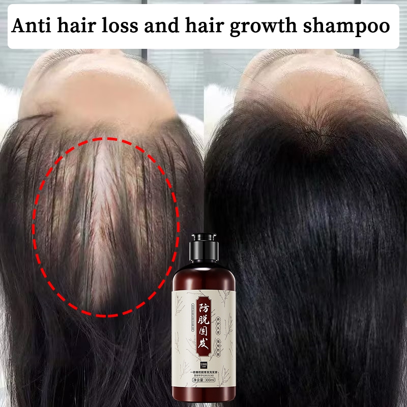 shampoo Control Oil Shampoo Anti Hair Loss Anti-dandruff Anti-itching ...