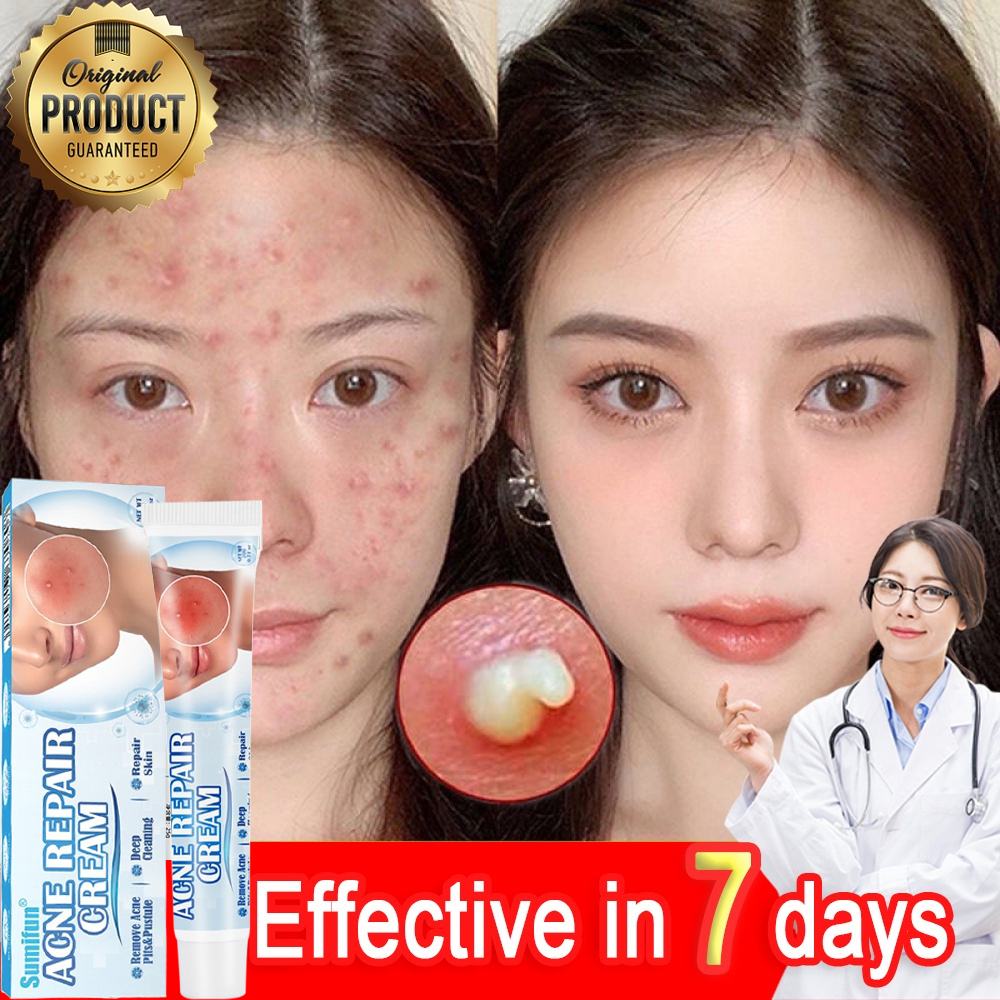Sumifun Acne Remover Cream 20g Pimple Marks Scars Remover Cream Acne