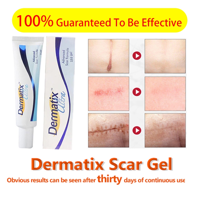 Dermatix 100%US Stretch Mark Cream original scar remover effectiv ...