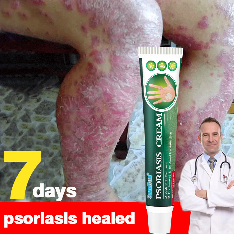 Psoriasis Eczema Cream Antibacterial Antiitching Ointment Fast Itch