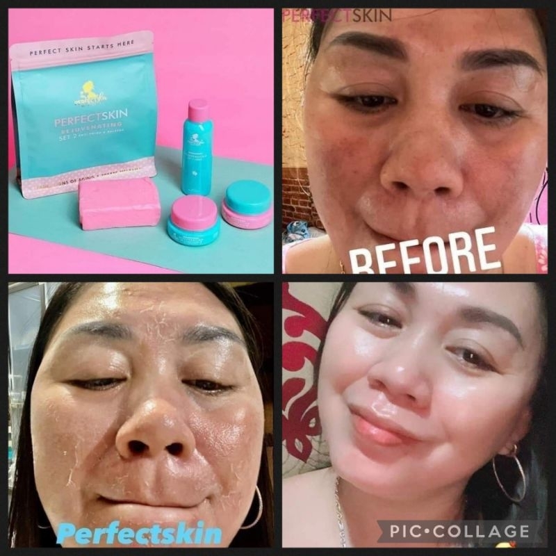 Perfect Skin Melasma Set | Shopee Philippines