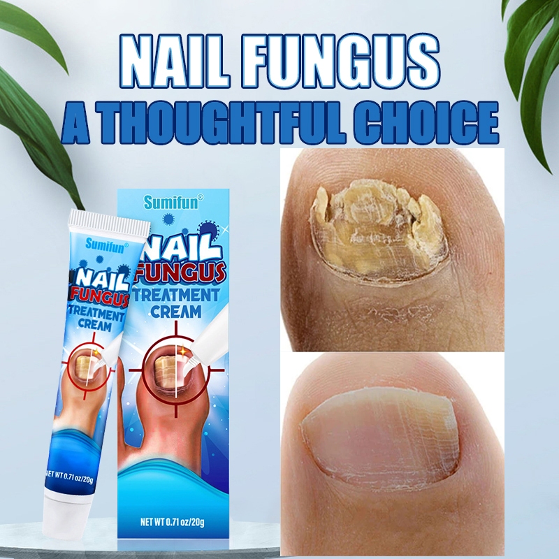 Nail Fungus Repair Treatment Cream Care Ointment Anti Fungal Anti