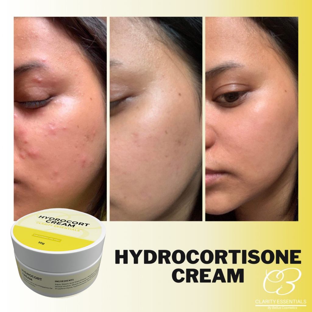 Shop hydrocortisone cream for Sale on Shopee Philippines