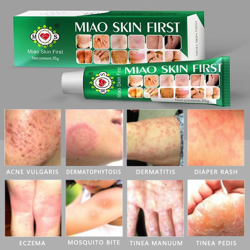 Packaging Miao Skin Frost 8g 15g 35g Original Product,anti fungal,acne ...