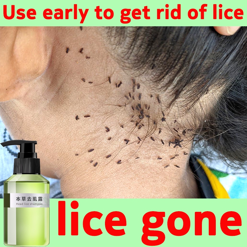 anti lice shampoo for kids lice removal shampoo 120ml Kills hair lice ...