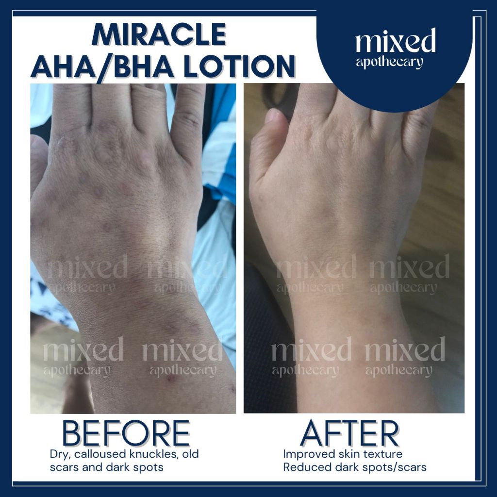 Miracle AHA/BHA LOTION for Dry Scaly Spotty Skin Best Lotion Shopee