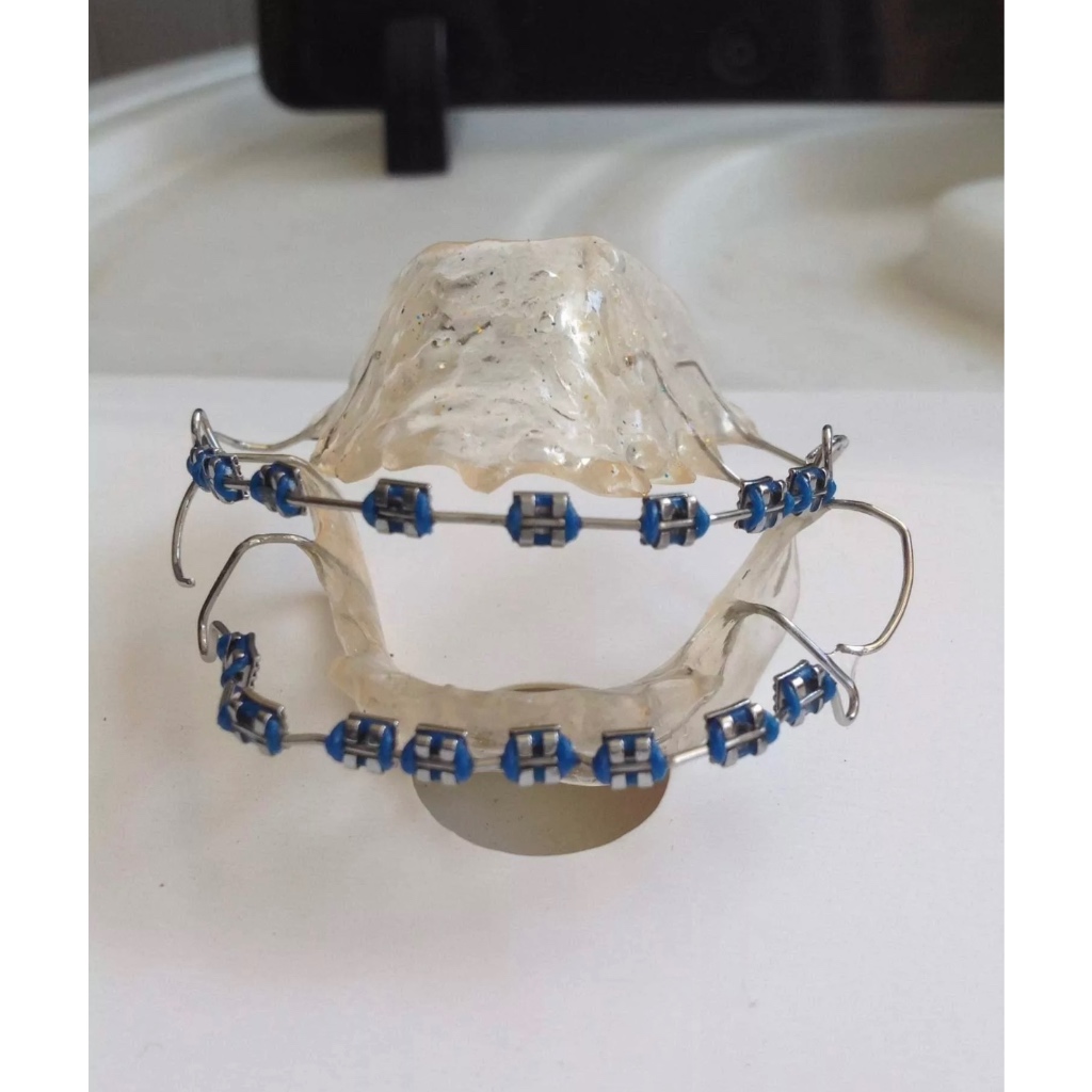 0B WITH GUMS ISUSUOT NALANG UP AND DOWN RETAINER LIKE BRACE_ Shopee