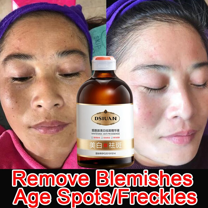 Melasma Serum Original Pekas Eraser Effective Anti Freckle Whitening Moisturizing Facial Essence