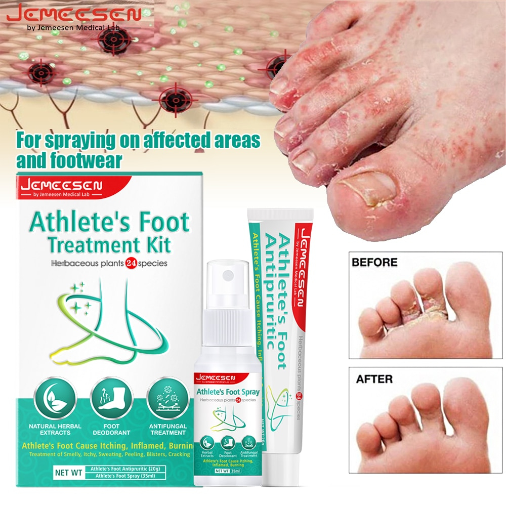 Herbal Foot Tinea Beriberi Pedis Cream Spray Anti Smelly itchy peeling ...