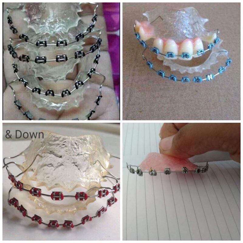 4B WITH GUMS ISUSUOT NALANG (UP&DOWN) RETAINER LIKE BRACE_a Shopee