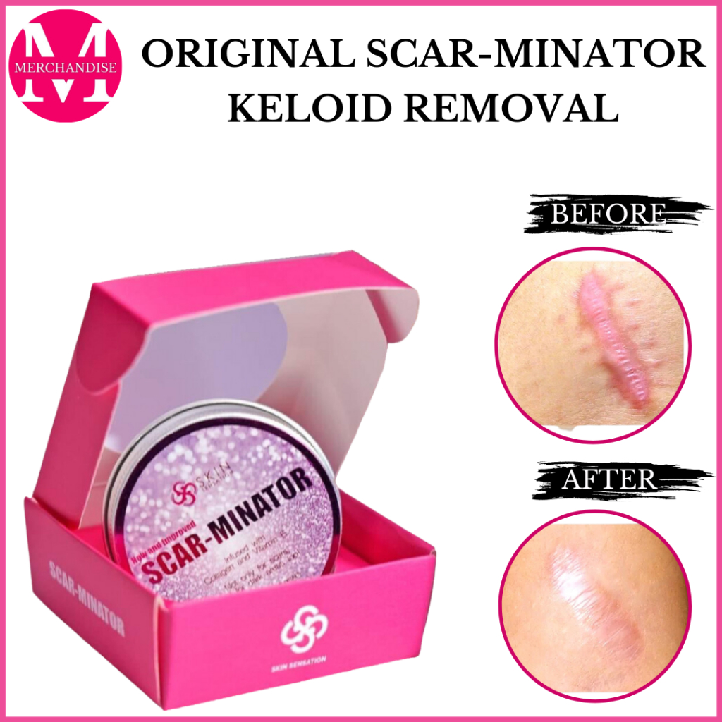 Scarminator Cream by Skin Sensation Best Scar Remover Acne Spots Keloid