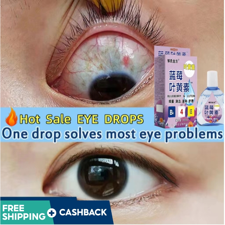 Blueberry Lutein Eye Drops Relieve Eye Fatigue Red Blood Streaks ...