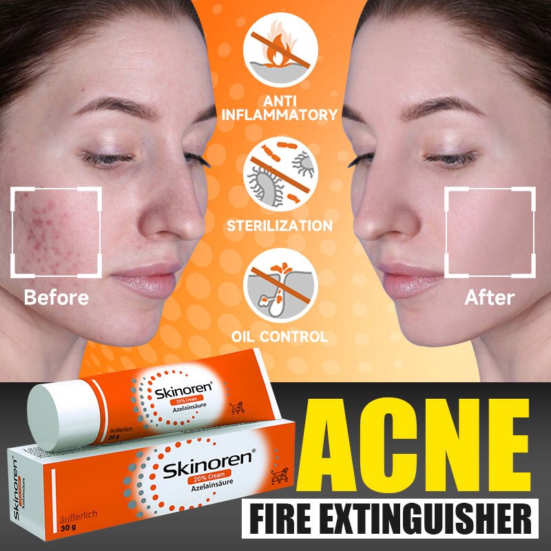 Acne Scars vs. Active Acne: Choosing the Right Treatment for Each ...