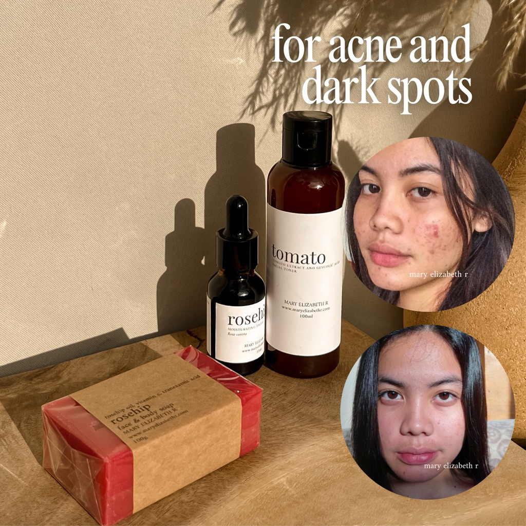 Rosehip Tomato Set for Acne Treatment and Dark Spots - Mary Elizabeth R ...