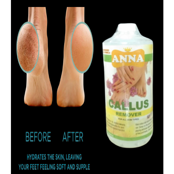 CALLUS REMOVER exfoliating dead skin 1000ml (different stickers, random ...
