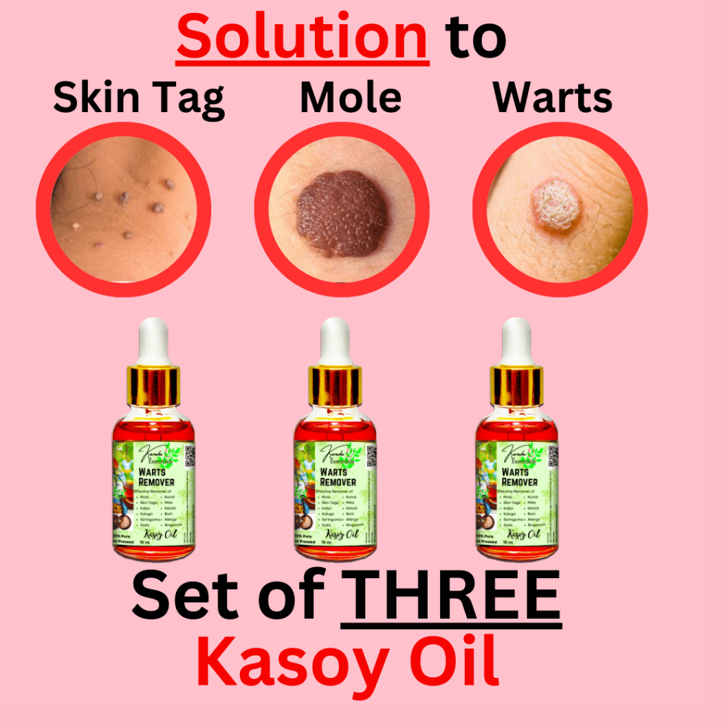 Authentic Kasoy Oil for Mole, Wart, Skin Tag Removal Quick Results ...