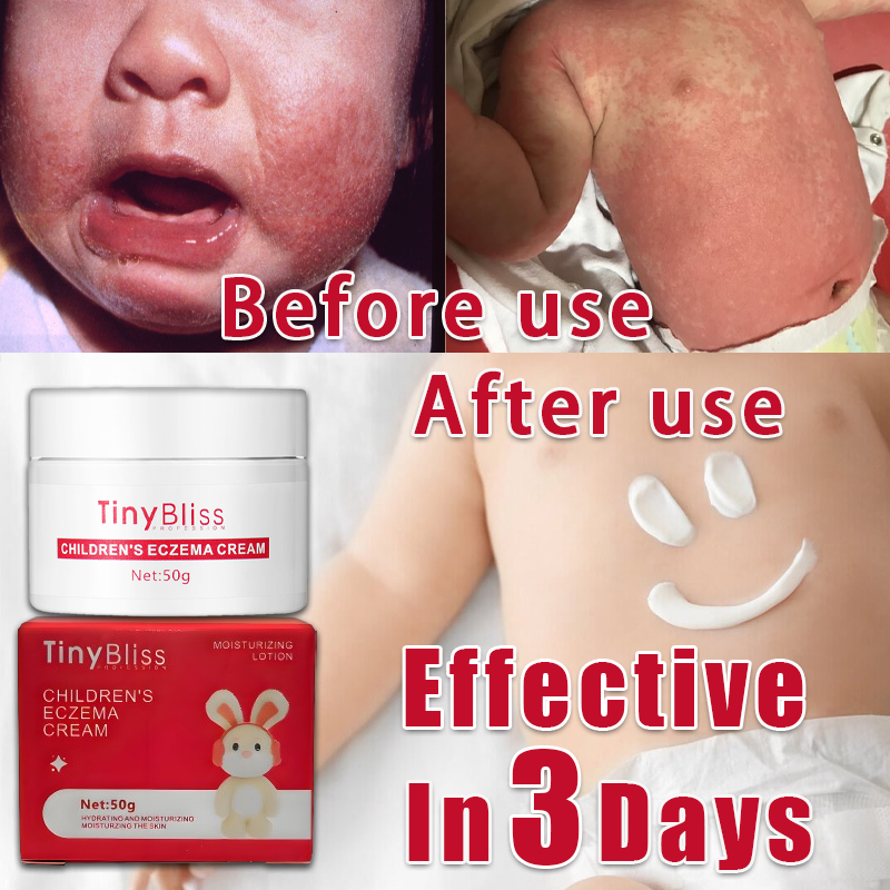 TinyBliss Rash Cream For Baby 50g Itch Relief Antiseptic Baby Eczema ...