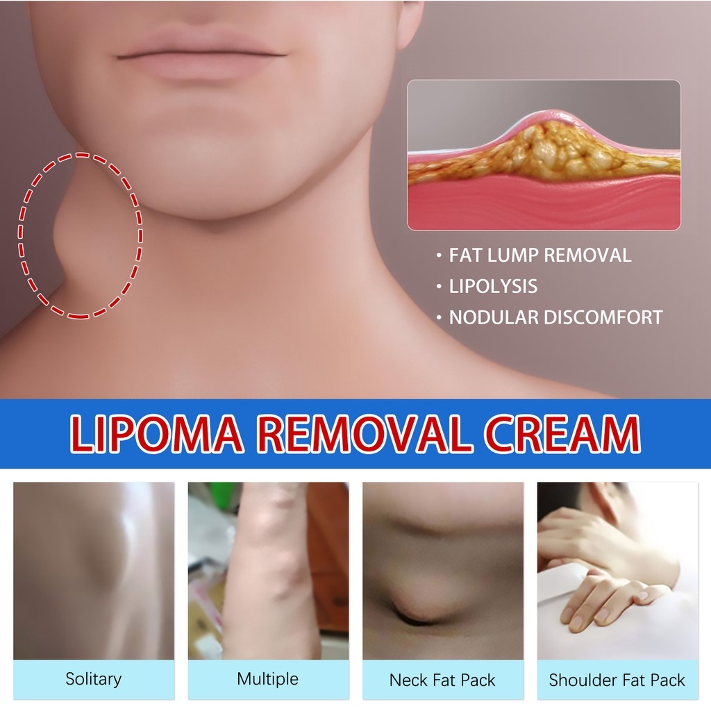 South Moon 20g Lipoma Removal Cream Lipolysis Fat Lump Relief Plaster ...