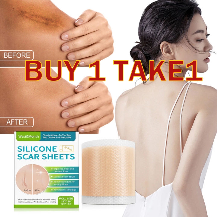 Silicone Scar Sheets Removal Tpy Patch Surgery Scar Removal Sticker ...