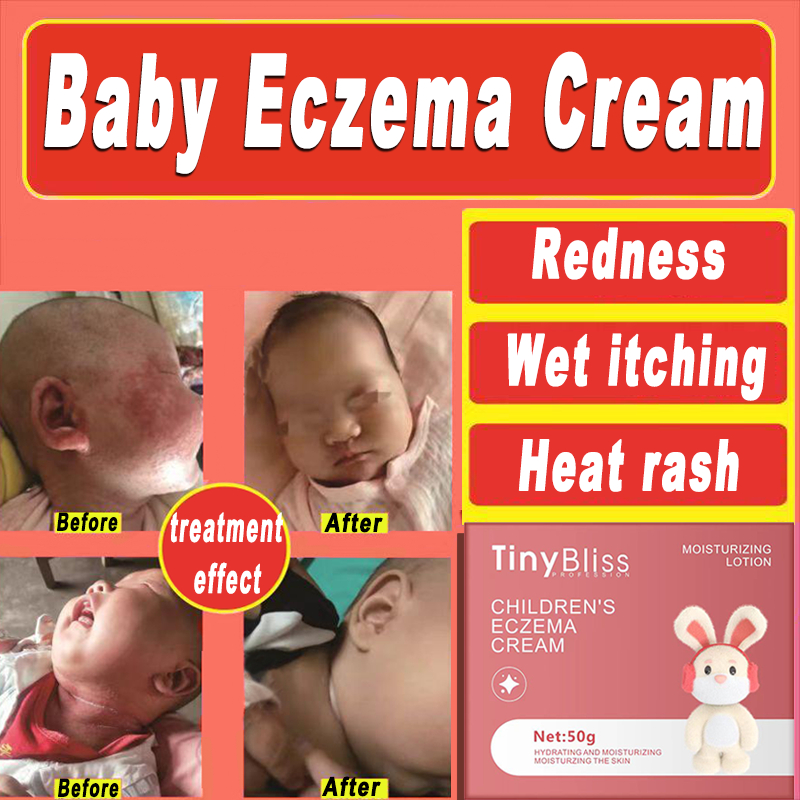 TinyBliss baby Eczema Cream Nappy Rash Relief Children Anti-Itch Cream ...