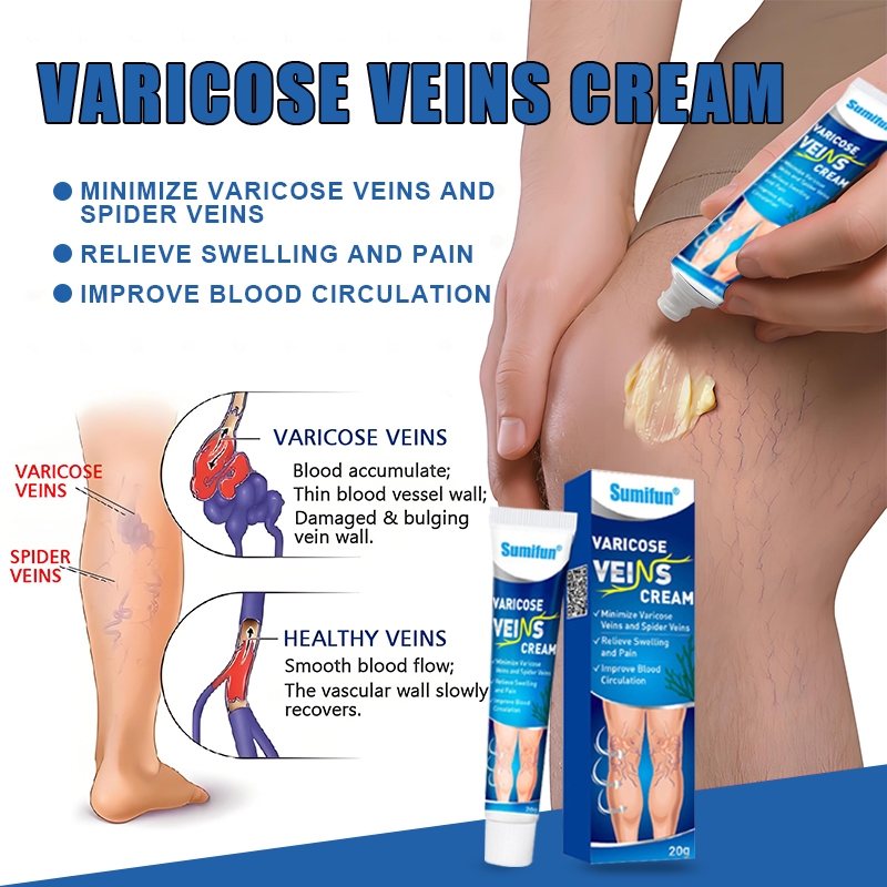 Varicose vein removal cream Effectively treats vasculitis,Relieves Pain ...