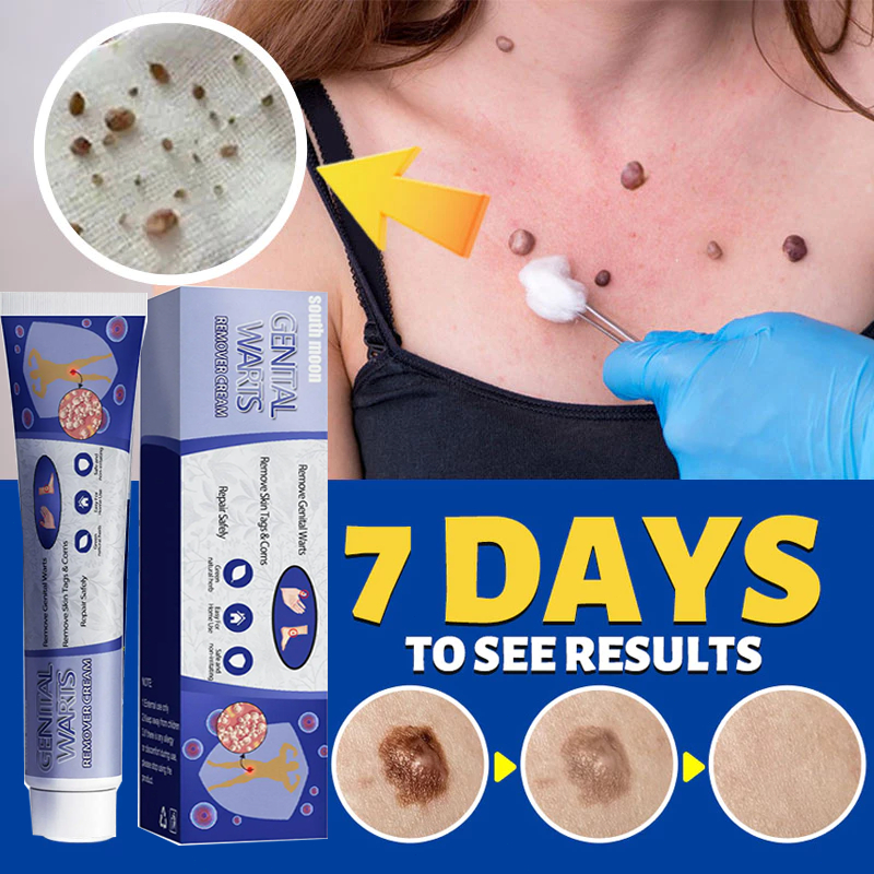 Warts Remover ORIGINAL Cream Wart Removal Ointment Kulugo Skin Tags ...