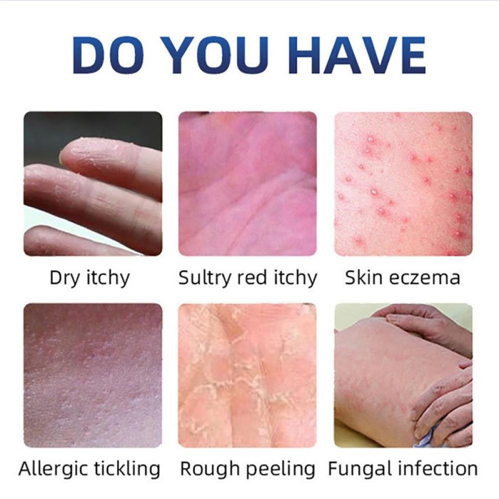 Psoriasis Cream Dermatitis Eczematoid Eczema Pruritus Ointment ...