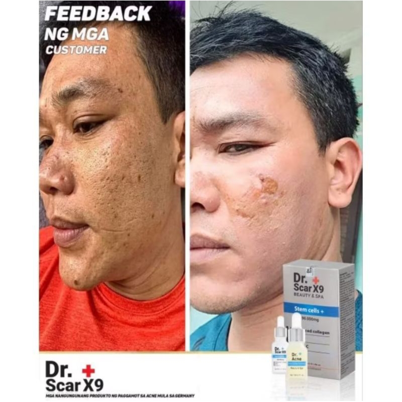 DR Scar X9 Authentic ( Goodbye Acne, Melasma Dar Spots ) | Shopee ...