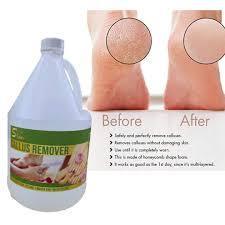 GALLON CALLUSE REMOVER - SALON SPA USED 1pcs (different stickers ...
