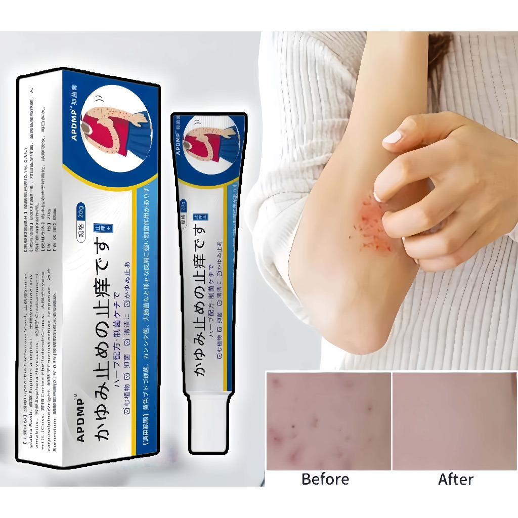 Anti-itch ointment 20g Highly effective in relieving itching Gentle and ...