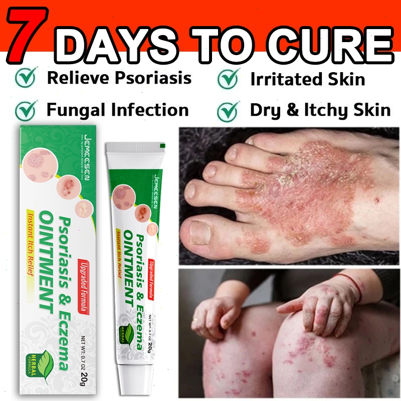 Jemeesen Eczema Cream Psoriasis Cream Relieve dryness And Scaling Itchy ...