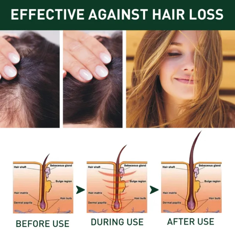 Rodil Ginger Hair Growth Shampoo For Dandruff And Itching Deep ...
